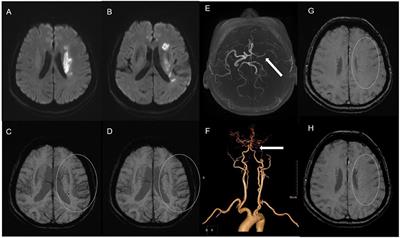 The Influence of Cerebral Arterial Circle on Prominent Hypointense Vessel Signs in Patients With Internal Carotid Artery Occlusion